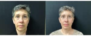 before and after blepharoplasty