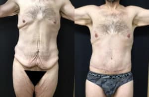 before and after body contouring after weight loss