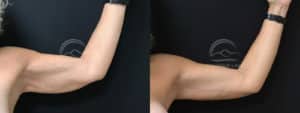before and after brachioplasty arm lift