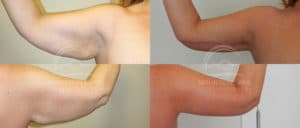 before and after brachioplasty arm lift