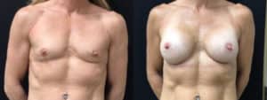 before and after breast augmentation