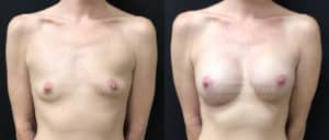 before and after breast augmentation