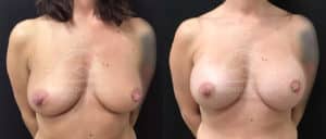 before and after breast augmentation