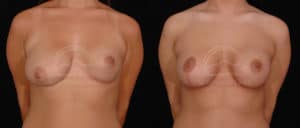 before and after breast augmentation