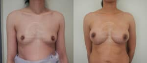 before and after breast augmentation