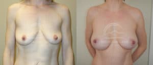 before and after breast lift with implants