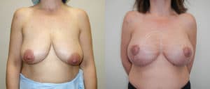 before and after breast lift with implants