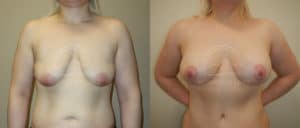 before and after breast lift with implants