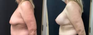 before and after breast lift with implants