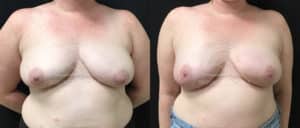 before and after breast reconstruction