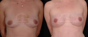 before and after breast reconstruction