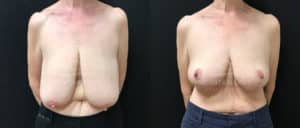 before and after breast reduction