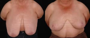before and after breast reduction