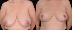 before and after breast reduction