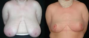 before and after breast reduction