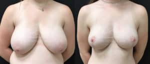before and after breast reduction