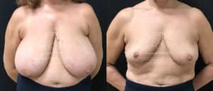 before and after breast reduction