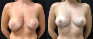 before and after breast reduction