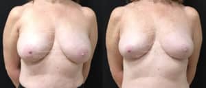 before and after breast reduction