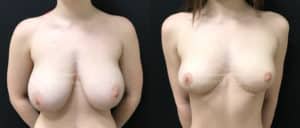 before and after breast reduction