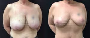 before and after breast reduction