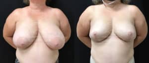 before and after breast reduction