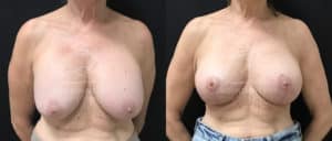 before and after breast surgery revision