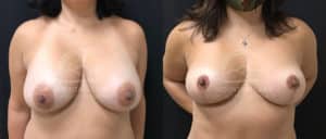 before and after breast surgery revision