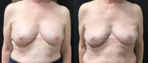 before and after breast surgery revision