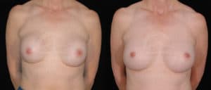 before and after breast surgery revision