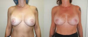 before and after breast surgery revision