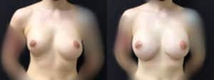 before and after breast surgery revision