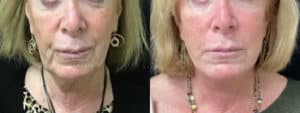 before and after facelift