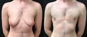 before and after ftm top surgery