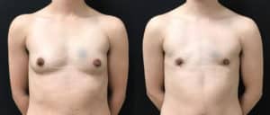 before and after ftm top surgery