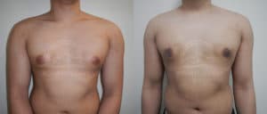 before and after gynecomastia