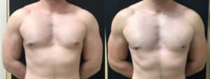 before and after gynecomastia