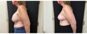 before and after implant removal