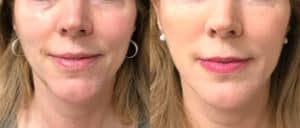 before and after injectables botox filler