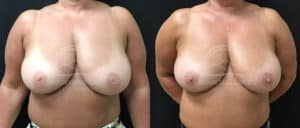 before and after inverted nipple correction