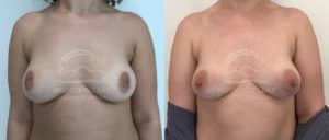 before and after inverted nipple correction