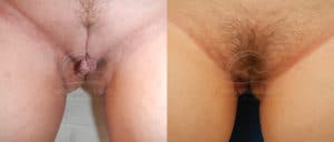 before and after labiaplasty