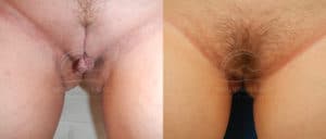 before and after labiaplasty