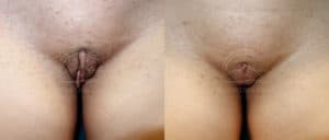 before and after labiaplasty