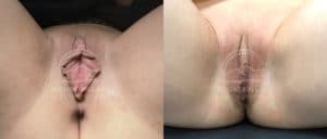 before and after labiaplasty