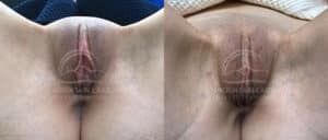 before and after labiaplasty