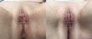 before and after labiaplasty