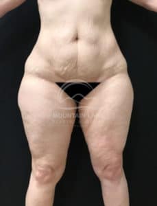 after liposuction