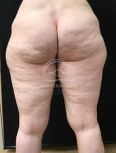 before liposuction