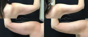 before and after liposuction